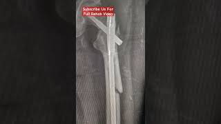 Fracture Physiotherapy  Femoral Neck Fracture  Physiotherapy in Karachi fracture physiotherapy [upl. by Ainolloppa]