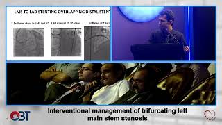 Interventional Management of trifurcating left main stem stenosis by Muhammad Waseem [upl. by Annahs]