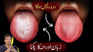 Never Get Oral Fungal Infection again  Home Remedy for Oral Thrush InqalabFareed [upl. by Sudnak]