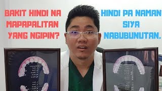 bakit hindi na tutubuan ng ngipin e hindi pa yan nabubunutan [upl. by Anairad]