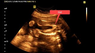 PREGNANCY PROFILE 2ND Trimester  ANOMALY STUDY [upl. by Pritchett315]