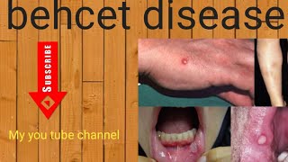 skin disease Behcet disease [upl. by Koser]