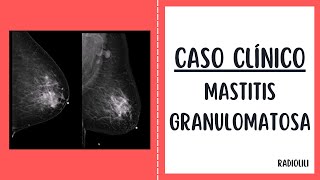 Caso Clínico 94 Mastitis granulomatosa [upl. by Heathcote409]