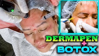 DERMAPEN  TOXINA BOTULÍNICA 🔥 Lo mejor para ARRUGAS FACIALES✅ CURSO GRATIS 💪👨‍⚕ [upl. by Arrio]