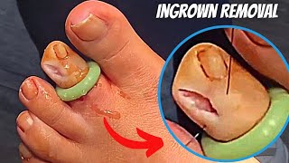 TREATMENT for INFECTED INGROWN TOENAIL by A Podiatrist surgery  How to cut ingrown amp pain relief [upl. by Hsirrehc]