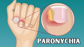 Paronychia  Causes Risk Factors Signs amp Symptoms Treatment  Everything You Need To Know [upl. by Garvin]