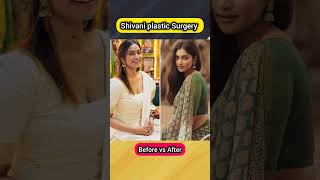 Shivani Narayanan plastic Surgery  Before and after challenge viralshorts actresslife [upl. by Shumway]