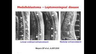 New Insights into Diagnosing and Treating Medulloblastoma [upl. by Kcirrag]