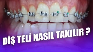 Diş Teli Nasıl Takılır Ortodontik Tel Tedavisi Nedir Ortodonti Tel Tedavisi Nasıl Yapılır [upl. by Mirelle]