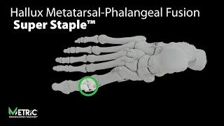 Hallux MetatarsalPhalangeal Fusion Video MPJ  Super Staple™ [upl. by Hwu]