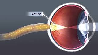 Animation Cataract [upl. by Garek]