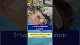 Seborrheic keratosis removal  Grace clinic Dehradun  Dr Naziya khatun [upl. by Lohcin]