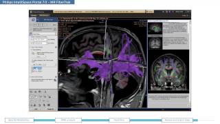 Philips IntelliSpace Portal 70 clinical application MR Neurology [upl. by Adnilrem130]