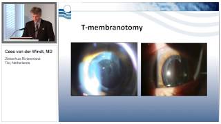 LaserMembranotomyinPatientsWithMultifocalIOLs [upl. by Aener]