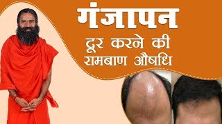 गंजापन  Baldness दूर करने की रामबाण औषधि  Swami Ramdev [upl. by Phaih]