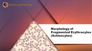 Morphology of Fragmented Erythrocytes Schistocytes [upl. by Hyman]