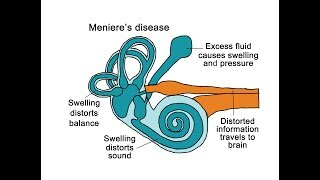 Menieres Disease [upl. by Rothenberg688]