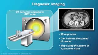 Pancreatic Cancer Pathophysiology Diagnosis and Staging [upl. by Esyle]