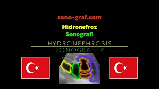 Sonografi  Hidronefroz [upl. by Uok]