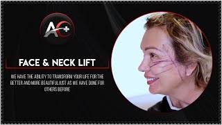 FACE amp NECK LIFT  AESTHEAL CLINIC [upl. by Scurlock]