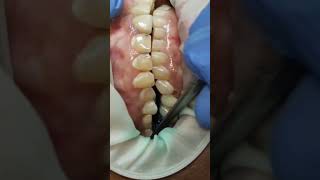 Checking 40 micron clearance for lower molar implant bridge [upl. by Dnomrej]