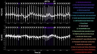 RealTime Electrocardiogram MITBIH Arrhythmia Database N209 with tag annotations [upl. by Aja]