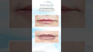 Why Hyaluronic Acid Fillers are Safer than PermanentSemiPermanent Fillers lipfiller [upl. by Anaya]