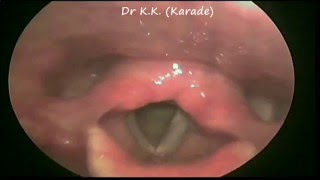 Video Laryngoscopy  Right Vocal cord paralysis following upper respiratory track infection URTI [upl. by Hearsh]