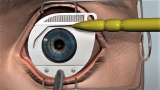 LASIK eye surgery  3D animation [upl. by Anetsirhc111]