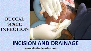 Incision and Drainage of Buccal space infection by Dr Raman Dhungel [upl. by Schulein584]