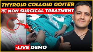 Thyroid Colloid Cyst  Experience of Treating Big Swelling Neck  Dr Gaurav Gangwani IR [upl. by Aneeles]