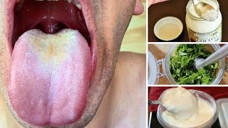 Best Home Remedies for Oral Thrush [upl. by Obeng68]