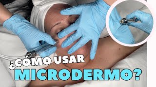 MICRODERMOABRASIÓN 😱 ¿Qué es ¿Cuándo usarla [upl. by Annert454]