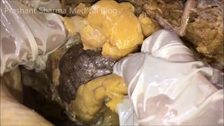 Kidney Dissection  Lobulated Demonstrated Paranephric Fat [upl. by Buckingham944]