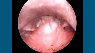 Base of TongueVallecula Swelling [upl. by Isoais326]