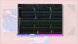 Part 5A of 6 Cryoballoon ablation for Atrial Fibrillation by Wilber Su [upl. by Nodnarg830]