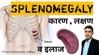 Splenomegaly  तिल्ली बढ़ना  Enlarged Spleen in Hindi  Spleen Enlargement Homeopathic Treatment [upl. by Enelegna]