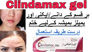 clindamax gel for acne reviews Climdamycin Treatment of acneHow to use clindamax gel side effects [upl. by Yrot995]