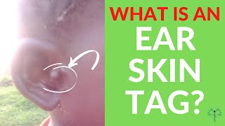 What are Ear Skin Tags  Dr ODonovan explains what they are why they form amp how they are treated [upl. by Normand]