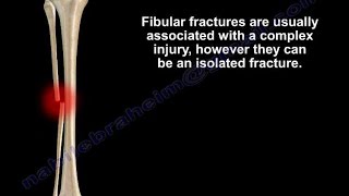 Fibular Fracture isolated Everything You Need To Know  Dr Nabil Ebraheim [upl. by Ydaj]