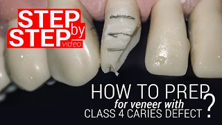 How to prep for veneer with class 4 caries defect Stepbystep video [upl. by Trotta]