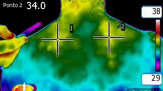 Termografia Médica na Acupuntura [upl. by Raychel]