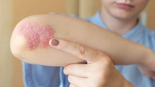 Psoriasis Explained by NIAMS [upl. by Woodman507]