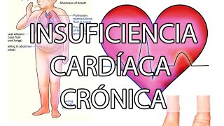 Clase de cardiología pregrado INSUFICIENCIA CARDÍACA CRÓNICA [upl. by Oaoj]