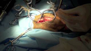 Excision arthroplasty [upl. by Denny487]