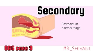 Secondary postpartum haemorrhage  OBG case study 9  RShivani PharmD PPH [upl. by Yci]