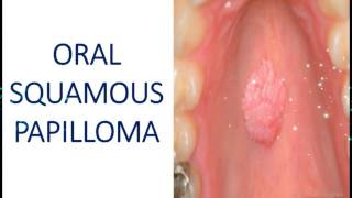 Oral Squamous Papilloma  Benign Tumour of Epithelial Tissue I Dental Guide I Dr Bimal Chand I [upl. by Lauter194]