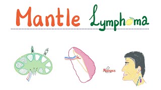 Mantle Cell Lymphoma  Aggressive BCell Neoplasm  NonHodgkin’s Lymphoma NHL  Hematology [upl. by Ellehcram]