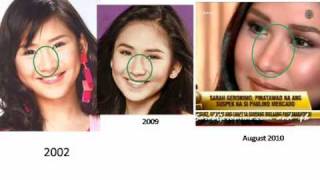 Sarah Geronimo Nose Job [upl. by Hetti337]