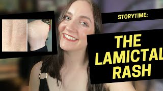 hell on earth the lamictal rash STORYTIME [upl. by Annawd903]